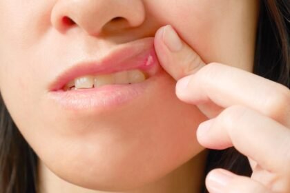 Tem aftas? O problema pode estar na sua pasta de dente